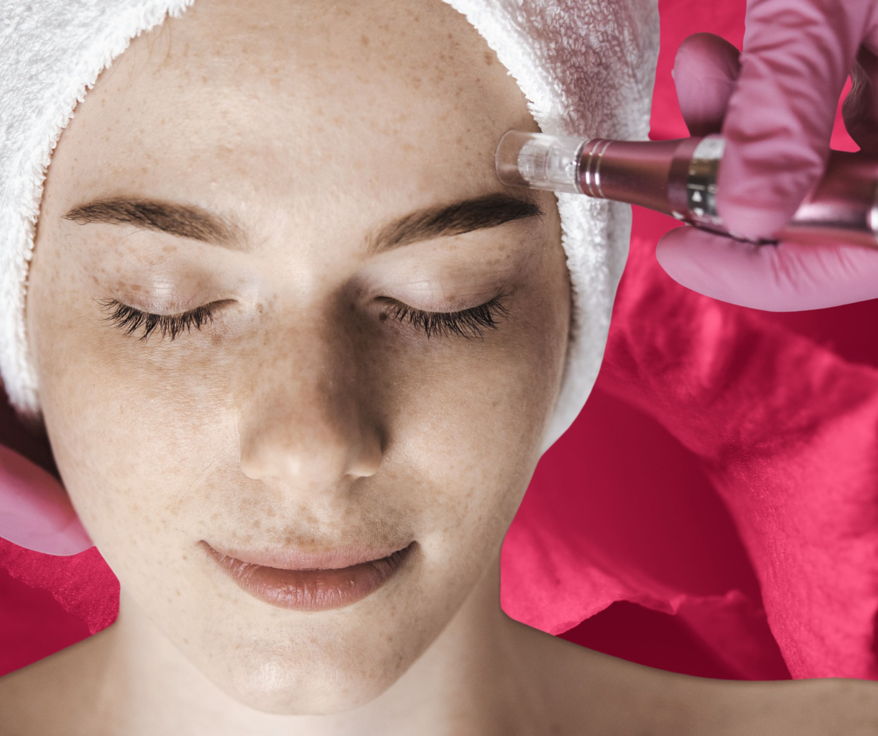 Microneedling