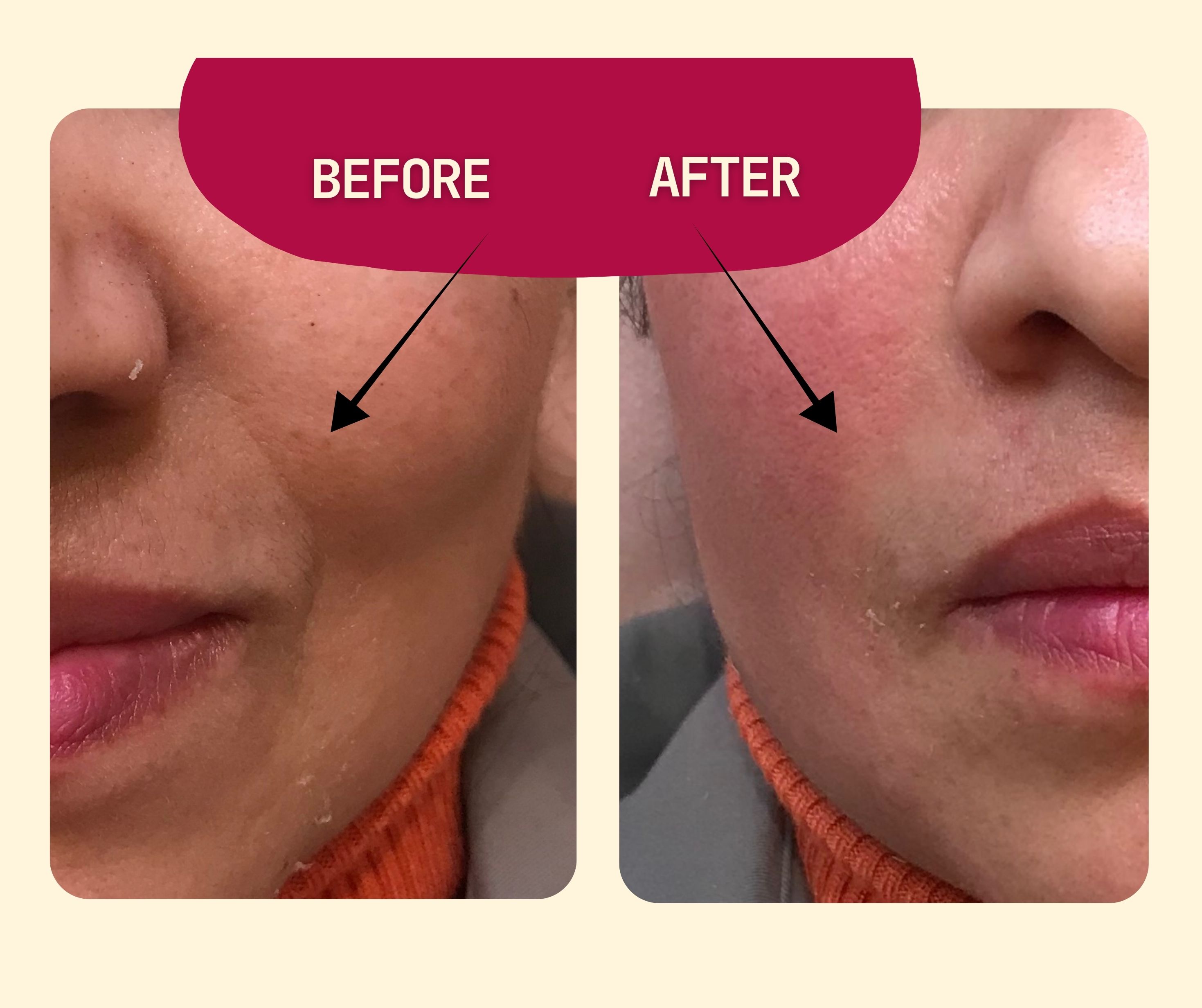 Before and After خط الابتسامة