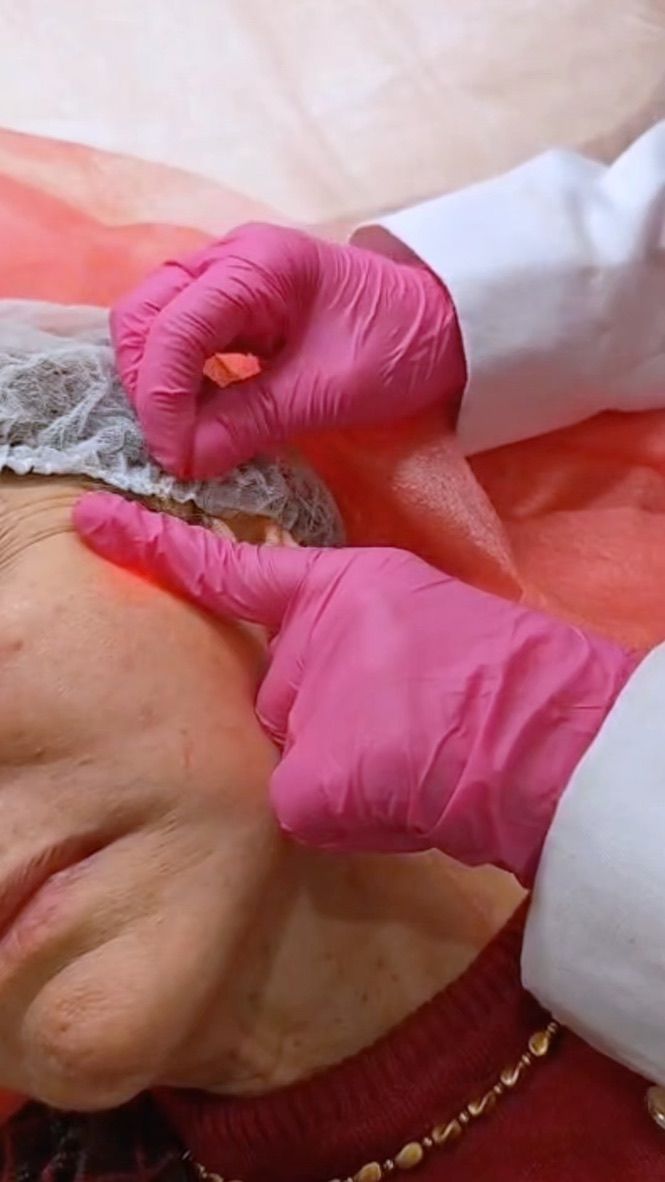 Endolift