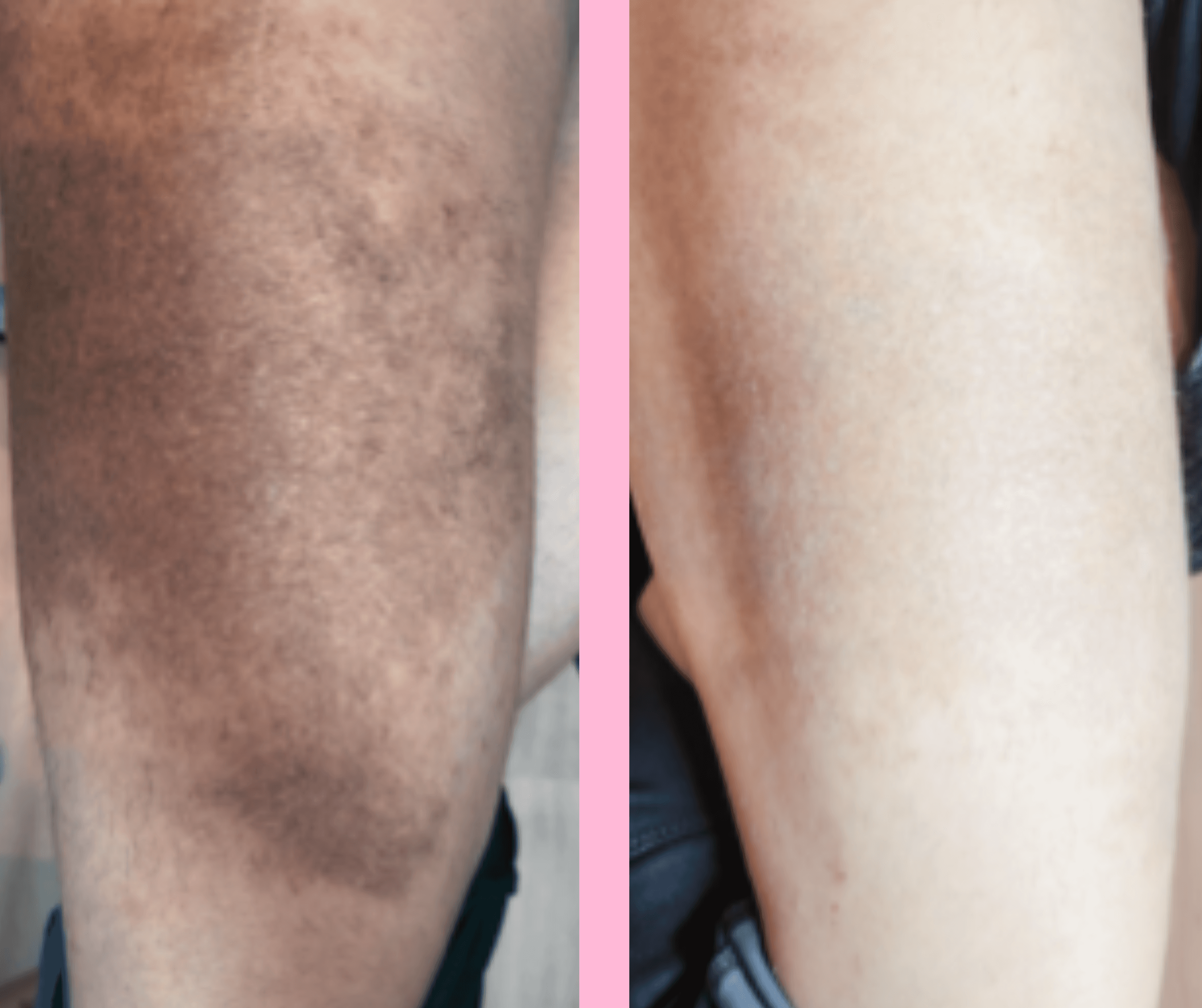Before and After Hyper-pigmentation Treatment