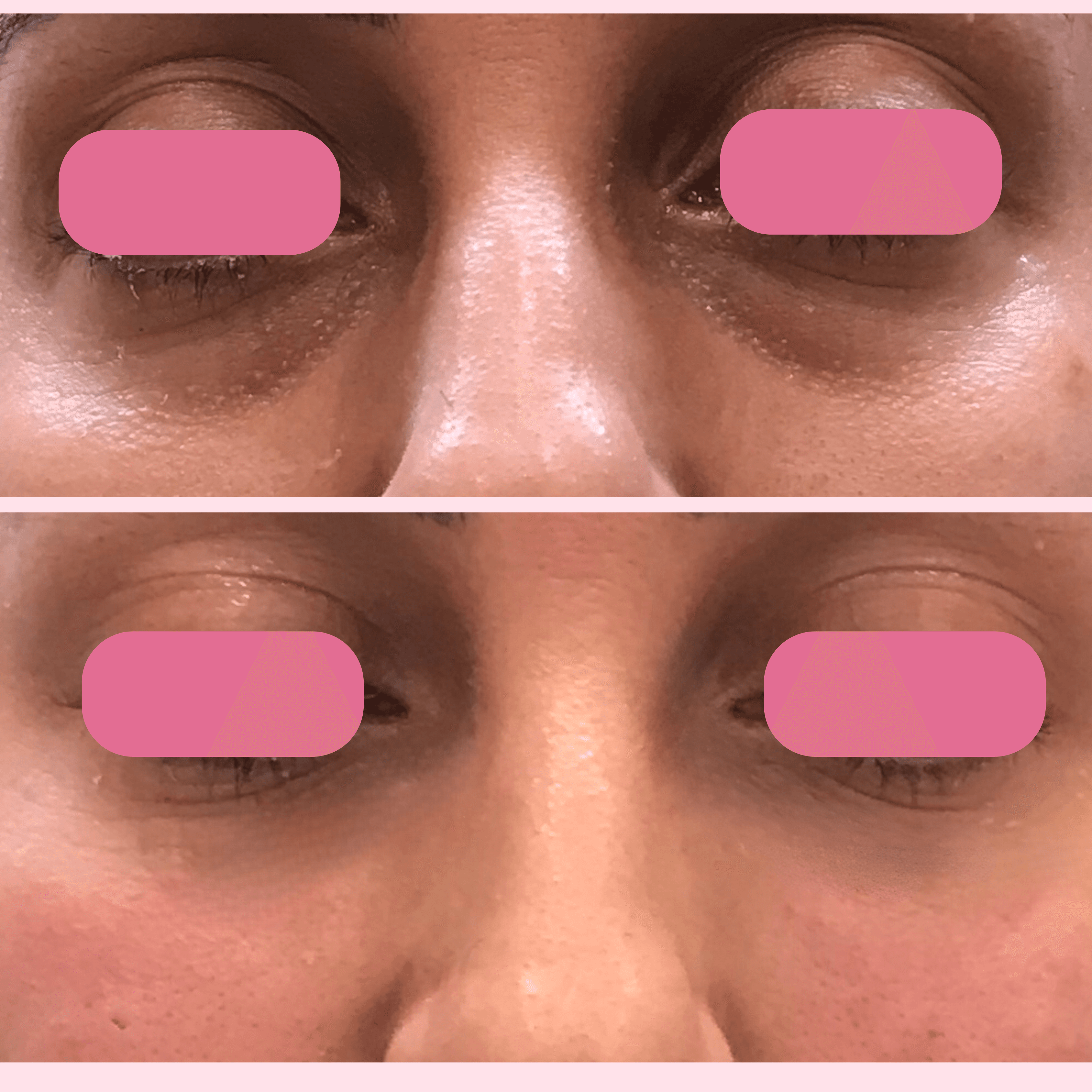 Before and After Under Eye Filler