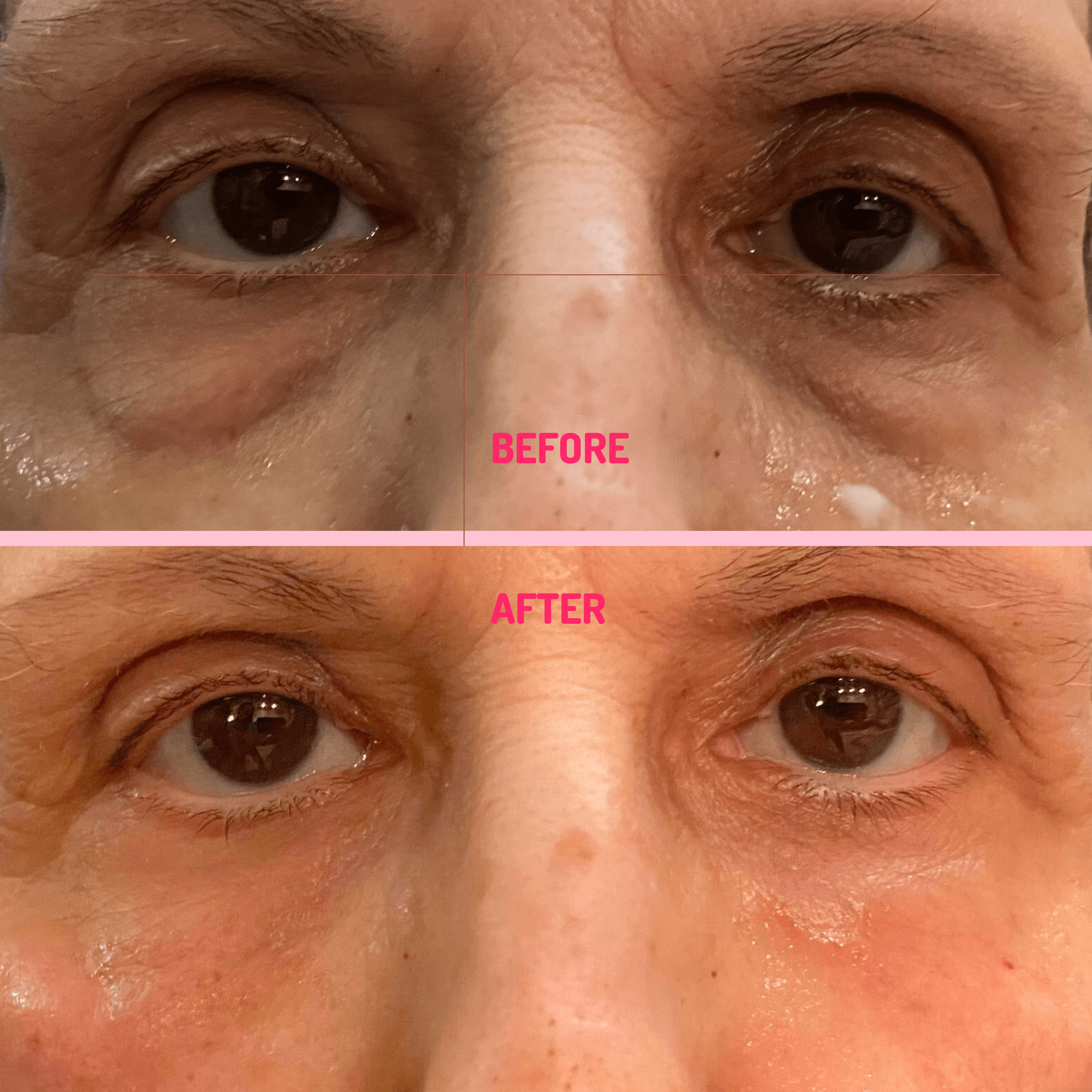 Before and After Smooth Eye