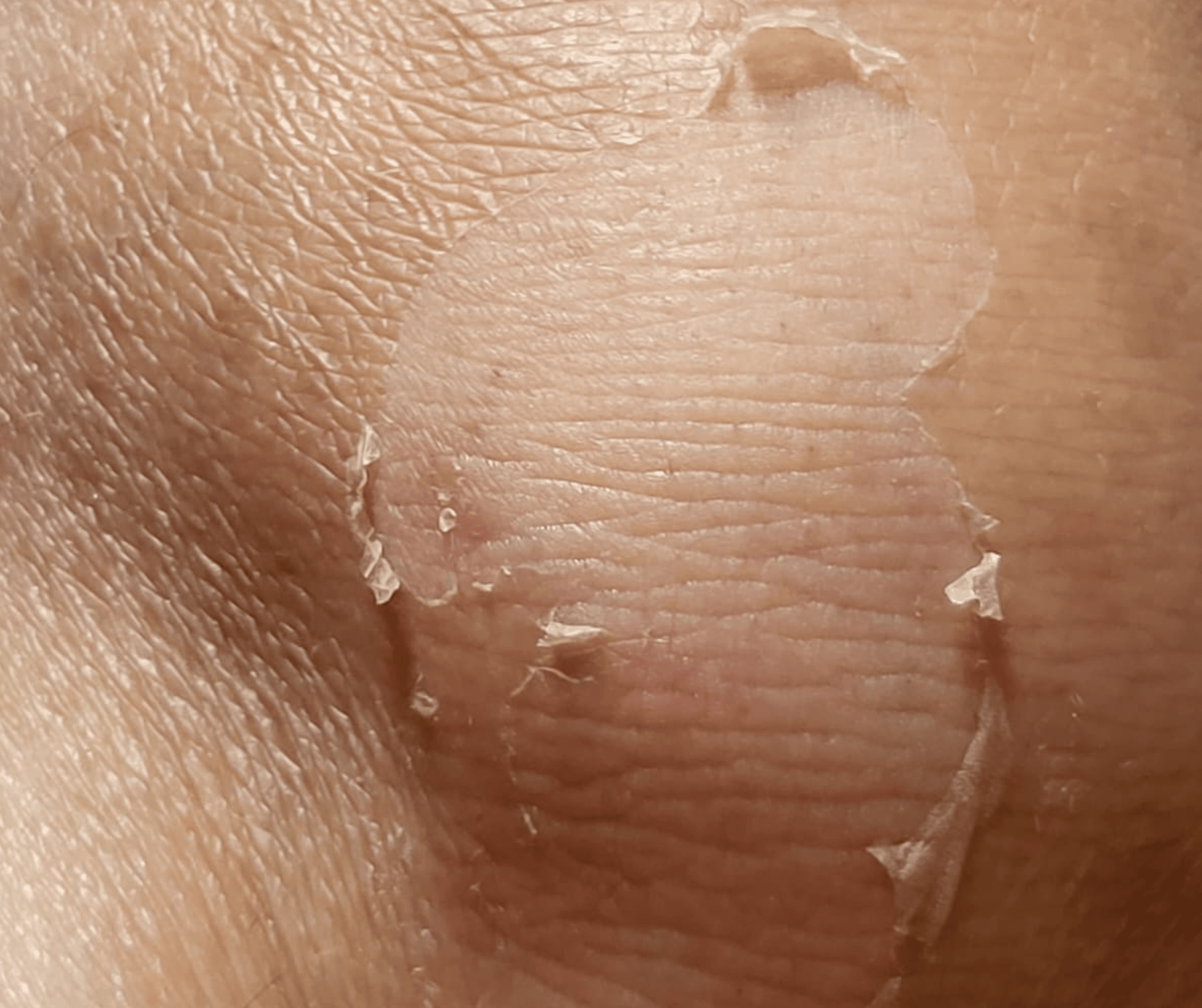 Before and After Cold Peel