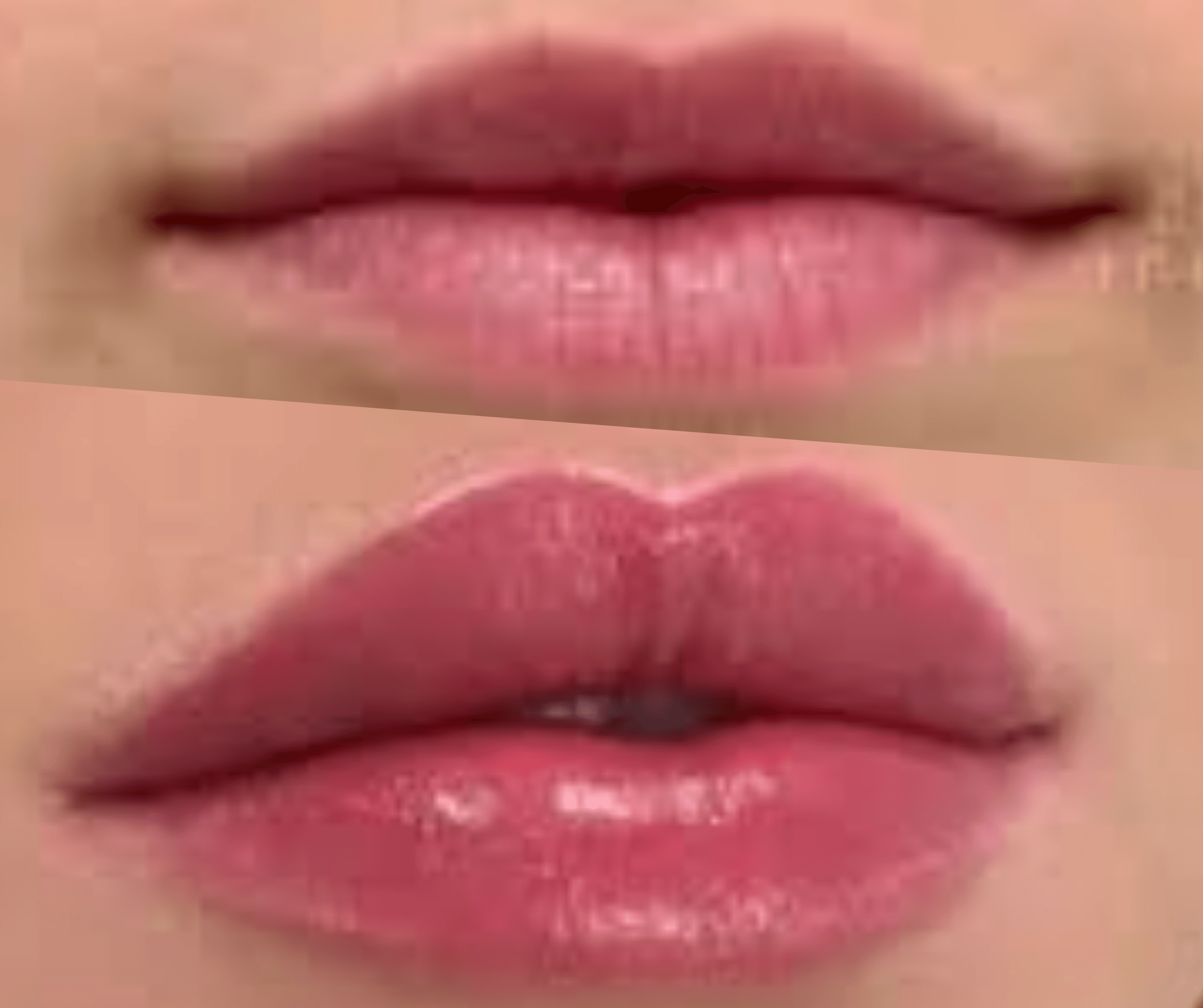 Before and After lip Filler
