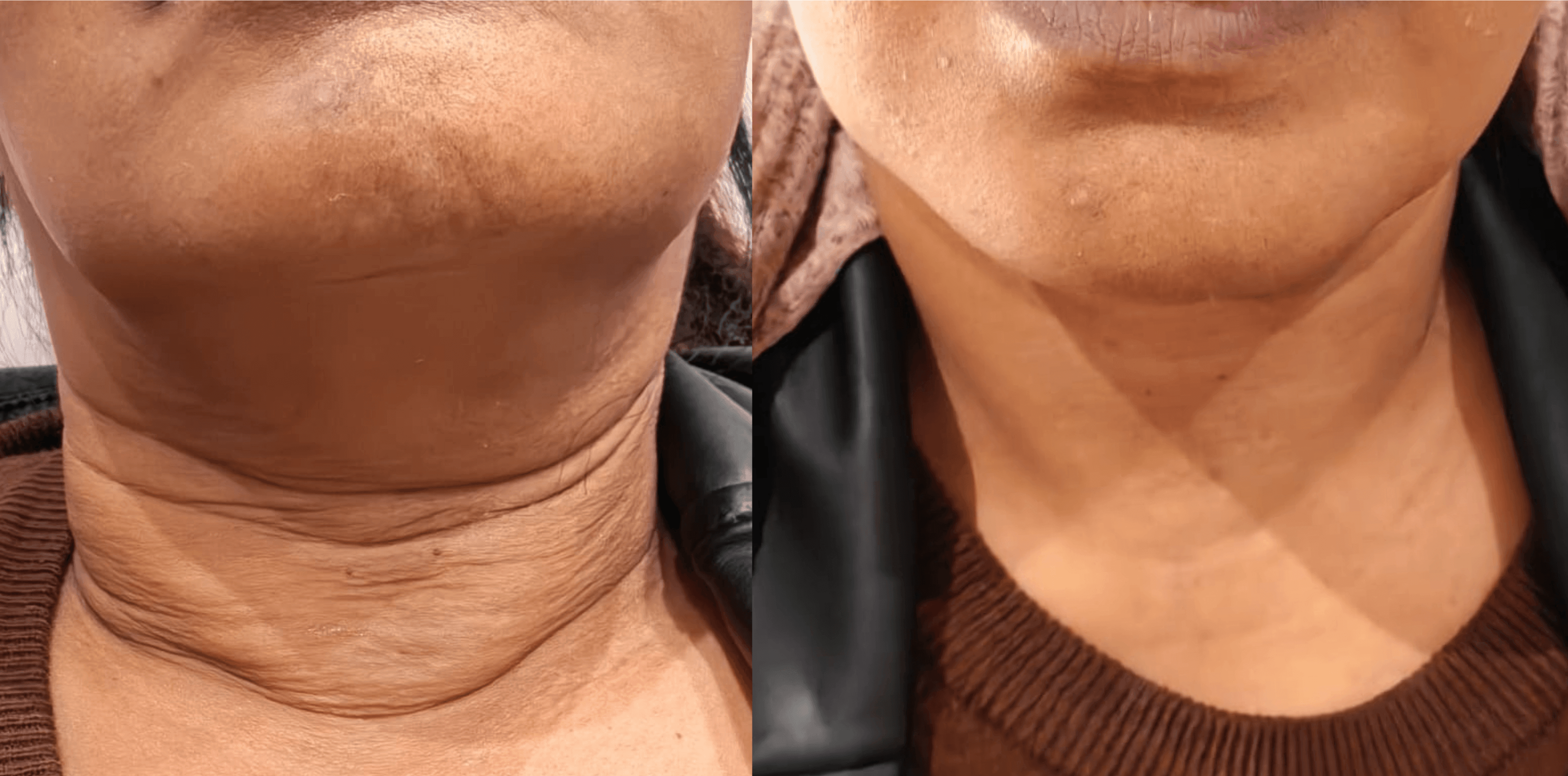 Before and After 4d Face Lift