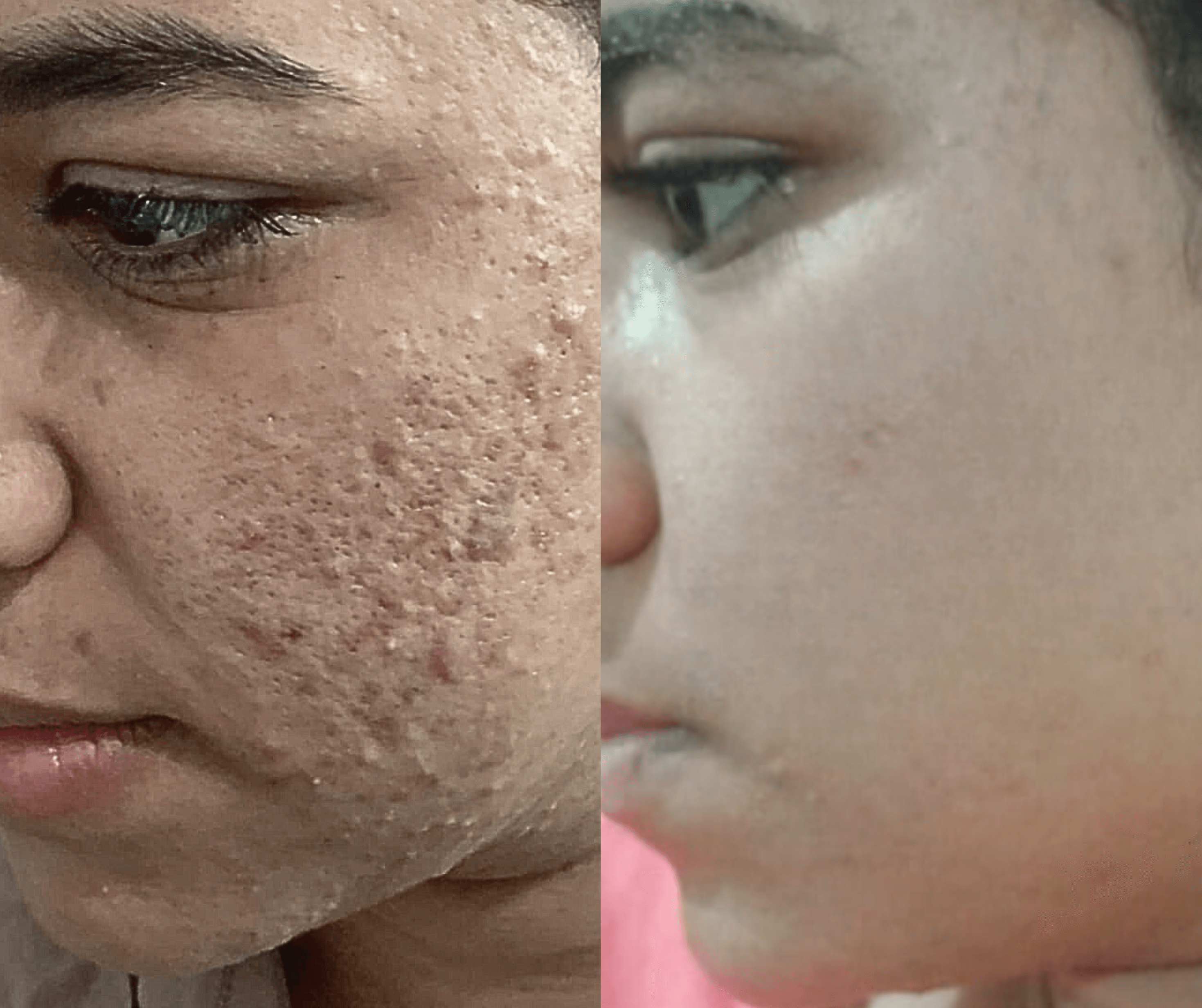 Before and After Laser Resurfacing